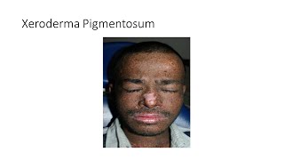 Xeroderma Pigmentosum [upl. by Rudman]