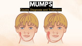 Mumps Causes Signs and Symptoms Diagnosis and Treatment [upl. by Pompea]