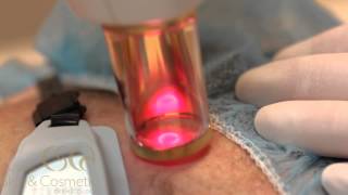 Photofractional Laser Treatment [upl. by Qidas]