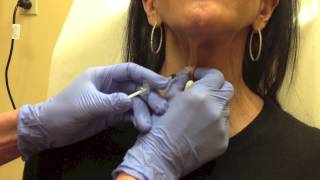 Botox for Platysmal Bands on Neck [upl. by Durtschi43]