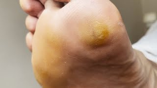 Professional treating cracked  Cracked treatment amp Callus removal  ASMR PART 1 [upl. by Ial]