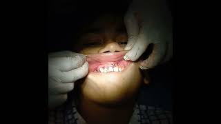 Eneucleation of periapical cyst [upl. by Potter]