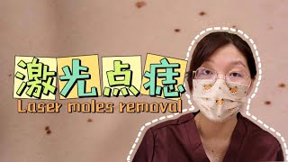 保姆级科普！激光点痣从治疗到护理Moles [upl. by Joy]