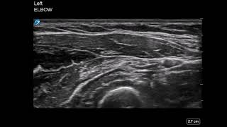 Elbow Ultrasound Radial Nerve Hydrodissection [upl. by Mosenthal873]