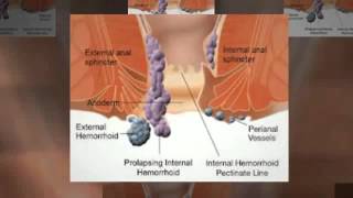 hemoroide interne [upl. by Ernestus]