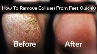 How To Remove Calluses From Feet  4 Easy Ways to Remove Calluses on Feet Quickly [upl. by Kletter]