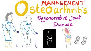 Osteoarthritis OA  Treatment  Degenerative Joint Disease  Rheumatology Series [upl. by Georgetta775]