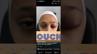 trauma to the eyelid VS cellulitis [upl. by Kipp812]