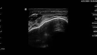 Knee Ultrasound Prepatellar Bursa Injection Part 1 [upl. by Vanessa999]