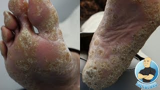 HOW TO TREAT REMOVE FOOT CALLUS  CALLOUS AND CORNS  FOOT HEALTH MONTH 2018 6 [upl. by Rebmeced]