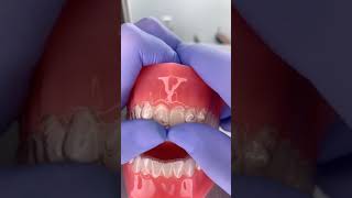 Invisalign tips [upl. by Rol]