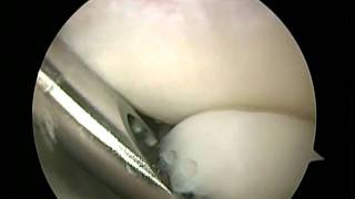 Elbow arthroscopy for arthritis bone spurs and loose bodies [upl. by Petronille]