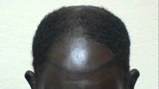 Hair Transplant Restoring Black African American Frontal Bald High Hairline wwwmhtacliniccom [upl. by Longmire527]