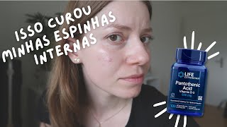 Peróxido de Benzoíla funciona para espinhas internas Como tratar a acne cística [upl. by Dunning]