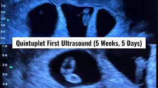 Our First Ultrasound at 5 Weeks amp 5 Days Its Five Finding Out We Were Having Quintuplets [upl. by Larret]