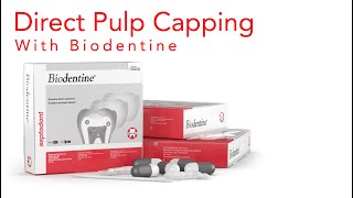 Biodentine Direct Pulp Capping  Improve Pulp Capping Success Rate  Techniques and Material 2022 [upl. by Jabez]