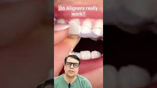 Do Aligners Really work youtubeshorts shortvideo shorts short teeth braces aligners [upl. by Ellainad]