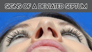 Signs of a Deviated Septum [upl. by Ihab284]