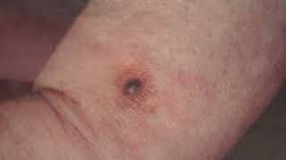 Learn 3 Types of Skin Cancer amp How They Look on the Skin [upl. by Fabri809]