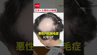 岡村社長に突撃！発毛日本一コンテスト出場者小林様について リーブ21 育毛 岡村社長 発毛 発毛塾 抜け毛 薄毛 髪の毛 発毛コンテスト [upl. by Elicia]