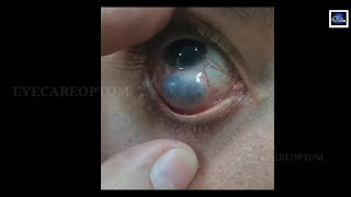 Guess the condition eyecareoptom conjunctiva eye eyeproblem [upl. by Eerrehc]