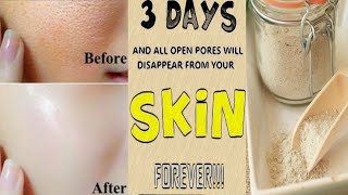 3 Days and all Open Pores will disappear from your SkinOpen pores Clogged pores100 results [upl. by Nyrat]