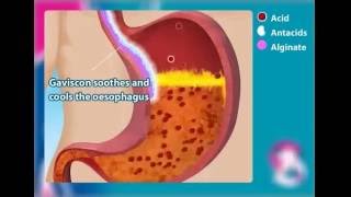 Gaviscon Double Action How it works [upl. by Zoeller]
