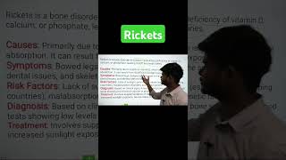 Rickets  causes  sign symptoms  diagnosis  treatment  in 1 min  rickets pksir [upl. by Ecyar]