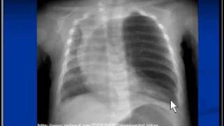 Chest xray Congenital lobar emphysema [upl. by Nniroc]