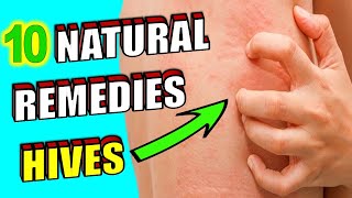 How To Get Rid Of Hives With The OxyHives Hives Treatment [upl. by Brotherson918]