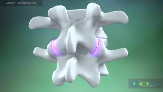 Spondylosis About [upl. by Aikemet]