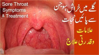 Sorethroat or pharyngitis causes symptoms and treatment with homoeopathy [upl. by Yroffej72]