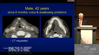 Imaging in hoarseness of voice  HD Basic Radiology [upl. by Abad]