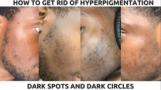 HOW TO GET RID OF HYPERPIGMENTATION DARK SPOTS AND DARK CIRCLES [upl. by Laemaj]