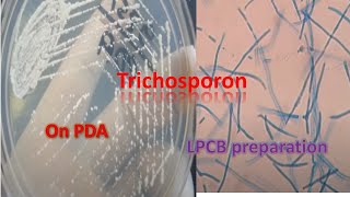 Trichosporon on SDA and LPCB preparation under the microscope [upl. by Idalla]