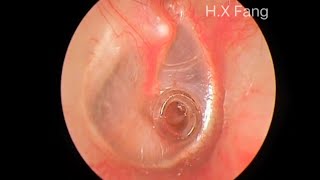 Tympanostomy tube surgery for secretory otitis media鼓室置管手术治疗分泌性中耳炎20230831 [upl. by Sheya]