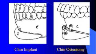 Large Chin Augmentation with Dr Barry Eppley [upl. by Niraa812]