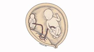 What is twintotwin transfusion syndrome TTTS [upl. by Witt193]