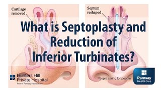 What is Septoplasty and reduction of Inferior Turbinates [upl. by Eittap]