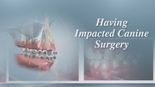 Having Impacted Canine Surgery [upl. by Eserrehs]