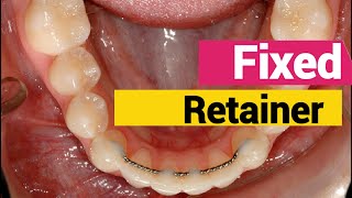 Bonding fixed permanent retainer in orthodontics [upl. by Aillil369]