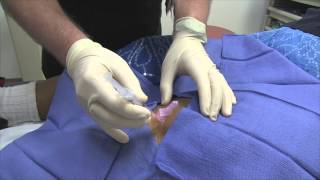 Pes Anserine Bursitis Steroid Injection [upl. by Asilav]