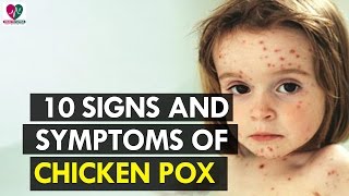 10 Signs and Symptoms of Chicken Pox  health Sutra [upl. by Yelhsa]