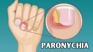 Paronychia  Causes Risk Factors Signs amp Symptoms Treatment  Everything You Need To Know [upl. by Radford]