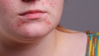 Acne  Accutane Benefits and Side Effects [upl. by Bunny153]