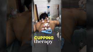 Cupping Therapy Cost 😳 amp Benefits 🙂‍↕️ [upl. by Ynoble]