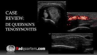 Ultrasound of de Quervain’s Tenosynovitis [upl. by Loeb]