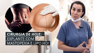 EXPLANTE COM MASTOPEXIA E LIPO HD COM DEFINIÇÃO LEVE [upl. by Duggan610]