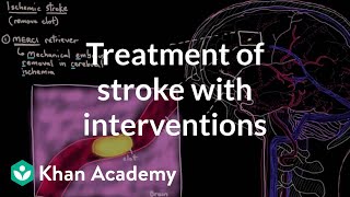 Treatment of stroke with interventions  Circulatory System and Disease  NCLEXRN  Khan Academy [upl. by Haroun]