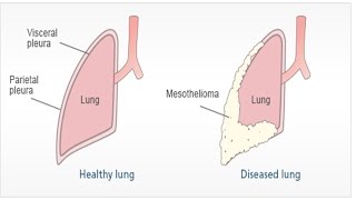 Pleural Mesothelioma  Asbestosis Symptoms and Treatment  Malignant Peritoneal Mesothelioma [upl. by Aimas]